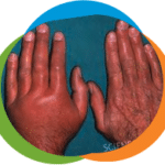 finger-gout-2