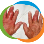 finger-gout-3