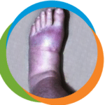 foot-gout-1