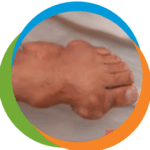foot-gout-3