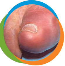 toe-gout-1